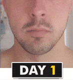 تكبير وملأ فراغات اللحية مع ديرما رولر